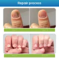 Toenail Fûngus Treatment, Nail Repair Liquid for Toenail and Fingernail, Restore Healthy Nails